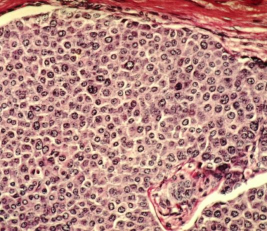 Вчені пояснили, як рак поширюється через кров