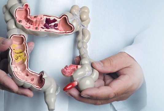 Как лечить геморрой