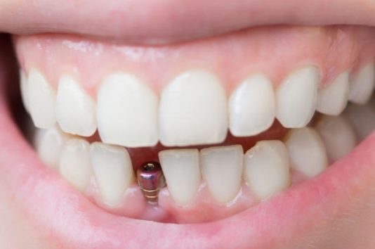 Срок службы зубных имплантов