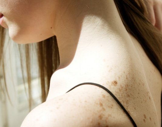 Рак шкіри: лікар перерахувала 8 ознак, які вказують на те, що ваша родимка може бути злоякісною